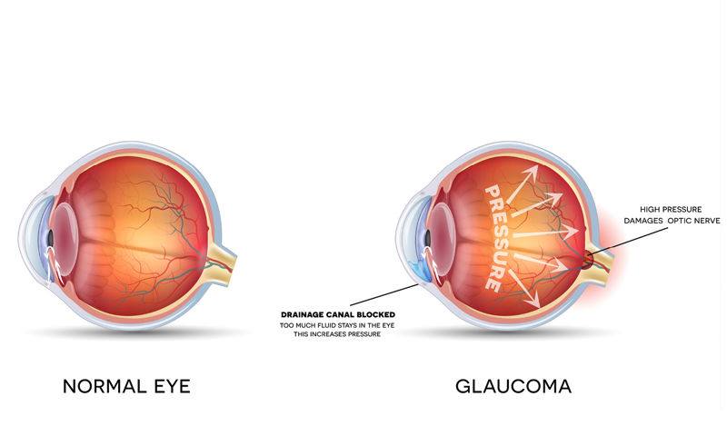 Glaucoma eye diagram